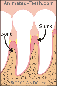 Link to  bacteria in periodontal pockets section.