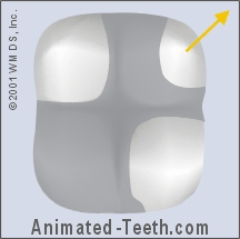 Slideshow of images of large dental fillings.