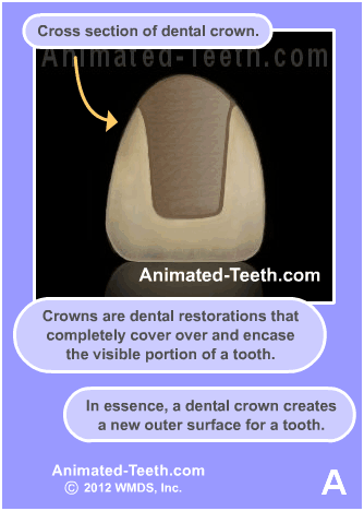 Slideshow explaining what dental crowns are.
