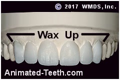 Picture of a diagnostic wax-up of a porcelain veneers case.