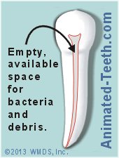 A tooth whose nerve has dies provides a prime location for bacteria to live.
