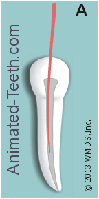 Animation of placing Gutta-percha to complete the root canal treatment process.