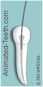 Animation of the filing action of a root canal file inside a tooth.