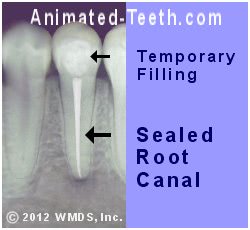 X-ray showing the temporary filling placed at the completion of a tooth's root canal treatment.