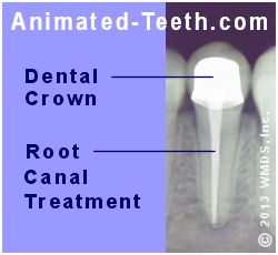 Link to research about placing a crown after endodontic treatment section.