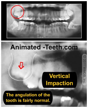 X-ray image of a vertical-type wisdom tooth impaction.