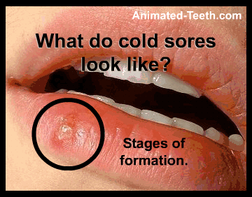 Cold Sore Fever Blister Stages Pictures Signs Symptoms Are They Contagious