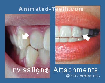 If Invisalign is Supposed to Be Invisible, What Are These Attachments For?
