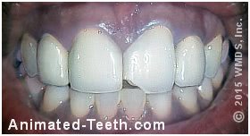 Picture of a broken porcelain-fused-to-metal dental crown on a front tooth.