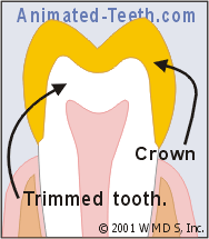 Illustration of a dental crown.