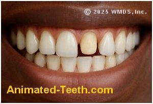 Picture of a smile with a missing dental crown.