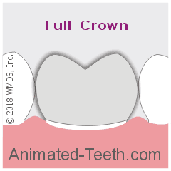 Animation showing: complete onlay, partial onlay, 3/4 crown, full crown.