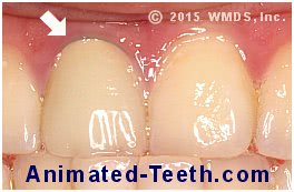 Picture of tooth with minor gum recession that reveals the dark edge of its PFM crown.