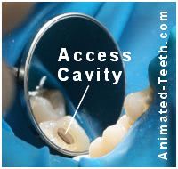 Picture of an access cavity made through a tooth's dental crown.