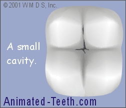 Animation show a small cavity repaired by placing a small dental filling.