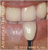 Picture of using a shade guide to determine the shade of a patient's teeth.