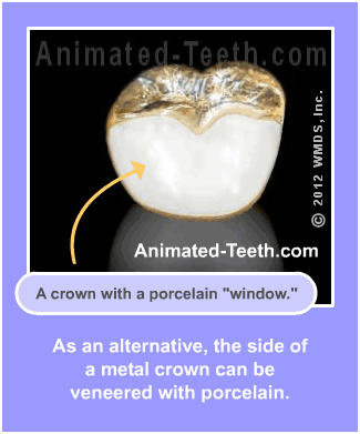 Slideshow explaining veneered dental crowns.