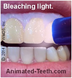 UV Lighting: Does it Work for Teeth Whitening? - Metro Smiles