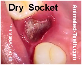dry socket wisdom teeth stitches