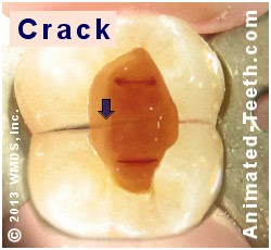 cracked molar