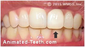 A dental crown that no longer matches the color of its neighboring teeth.