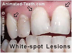 light brown spots on teeth near gums