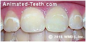 Picture of white spot lesions resulting from poor oral home care during braces treatment.