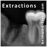 bone fragments after tooth extraction