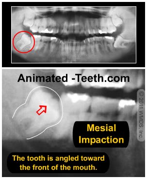 impacted wisdom tooth horizontal