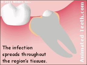 pericoronitis infection